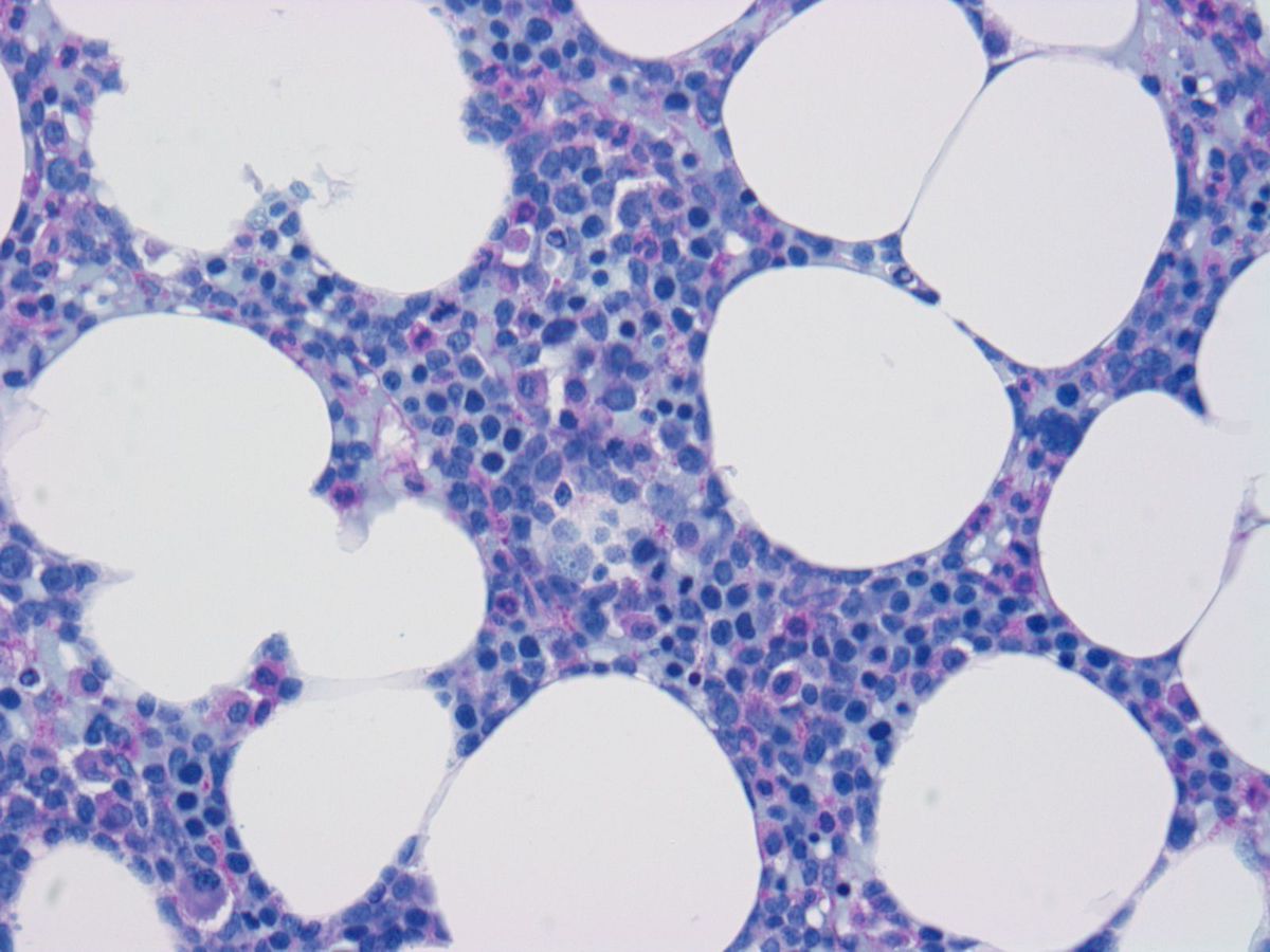 Bone marrow Biopsy PAS stain: Interstitial infiltration of small to intermediate sized blasts